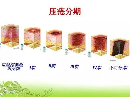 深度解析：最新压疮分期标准、临床应用及未来展望