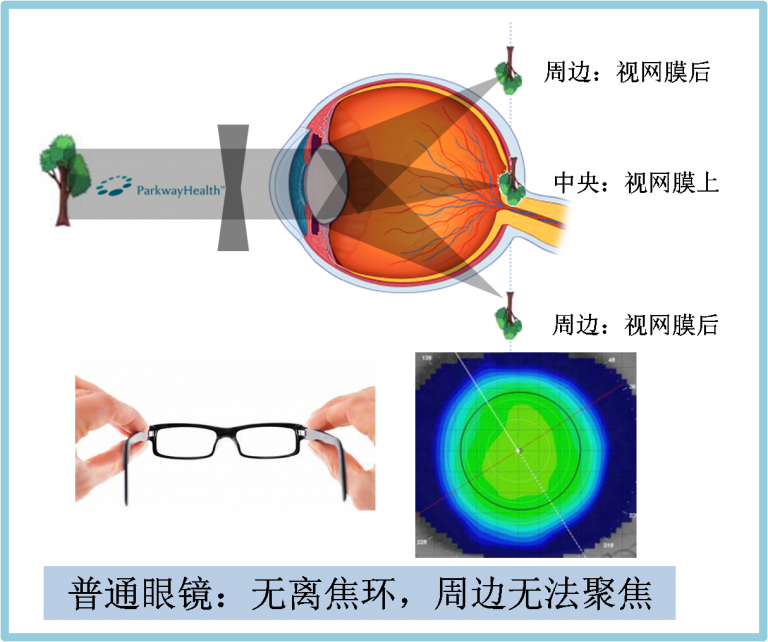 儿童近视最新治疗方法：多维视角下的防控与矫正策略