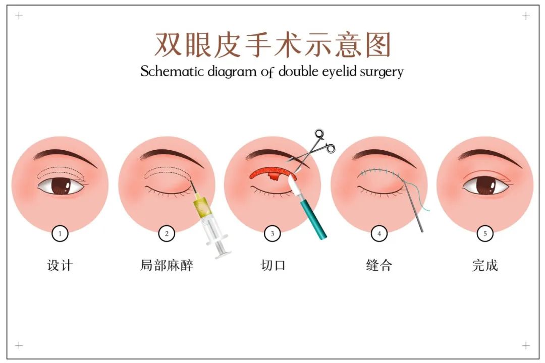 最新双眼皮术实施技术前沿与发展趋势：从技术到保养