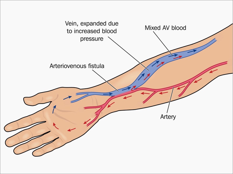 静脉瘘最新研究进展：透析患者血管通路新策略及挑战