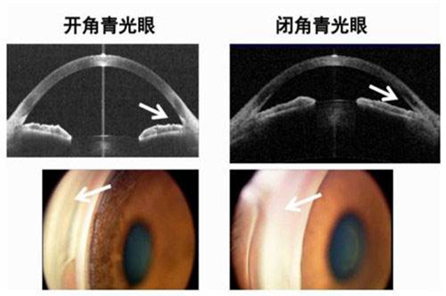 开角型青光眼最新治疗进展：药物、手术及未来展望