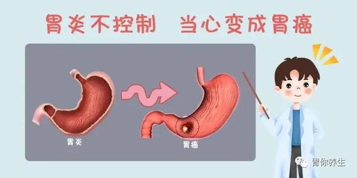 胃病最新指南：解读胃部疾病诊疗新策略及未来发展趋势