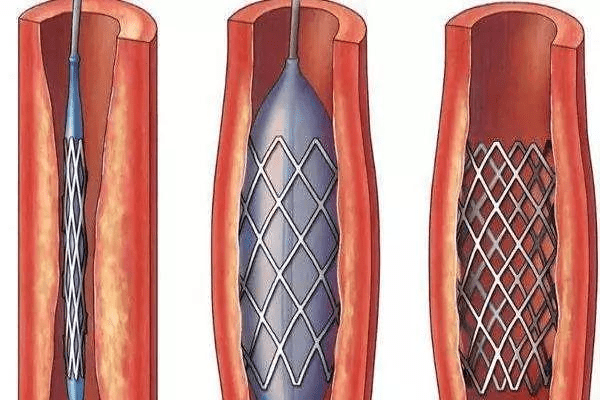 支架再狭窄最新进展：生物可吸收支架、药物洗脱支架及未来发展趋势