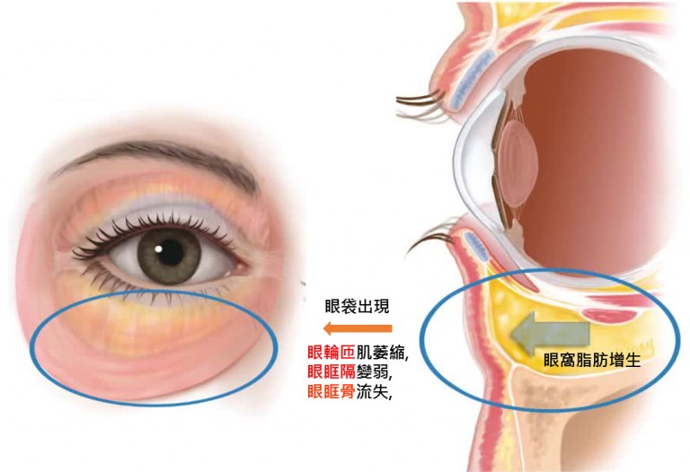 最新眼部手术技术革新与未来展望：重睑术、近视手术及眼袋修复的突破性进展