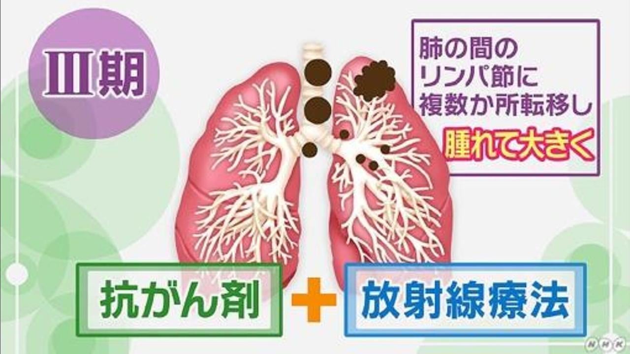 最新肺炎图例深度解析：病毒变异、传播途径及防护策略